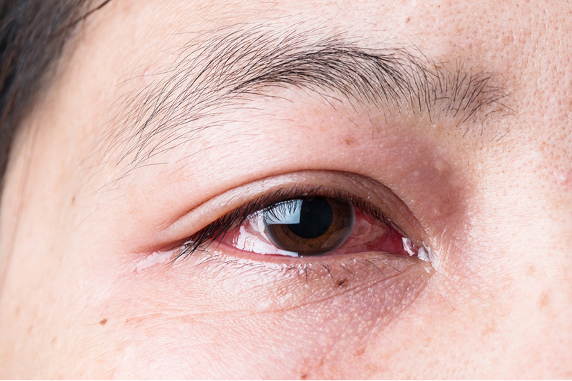 keratita oftalmologie picături de vedere uscată