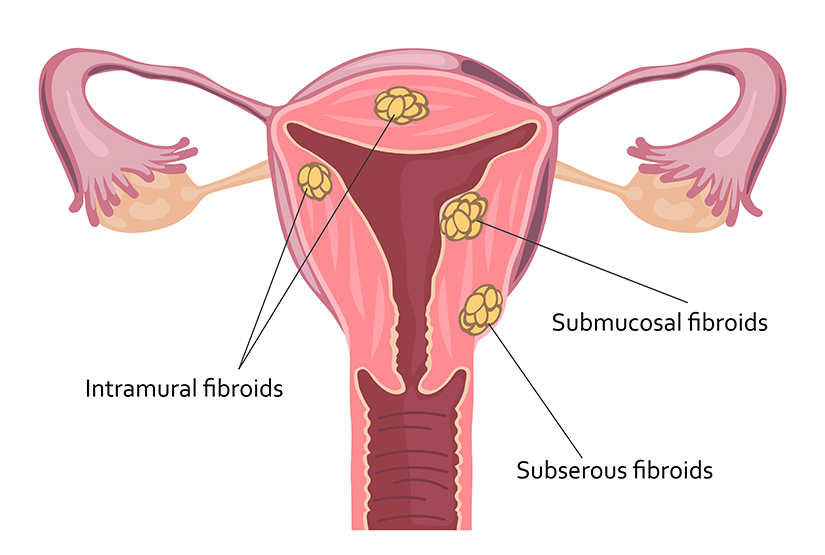 pierderea în greutate ajută fibroamele uterine