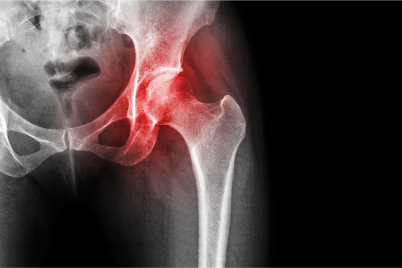 tratamentul artrozei deformante post traumatice a genunchiului reiterův syndrom