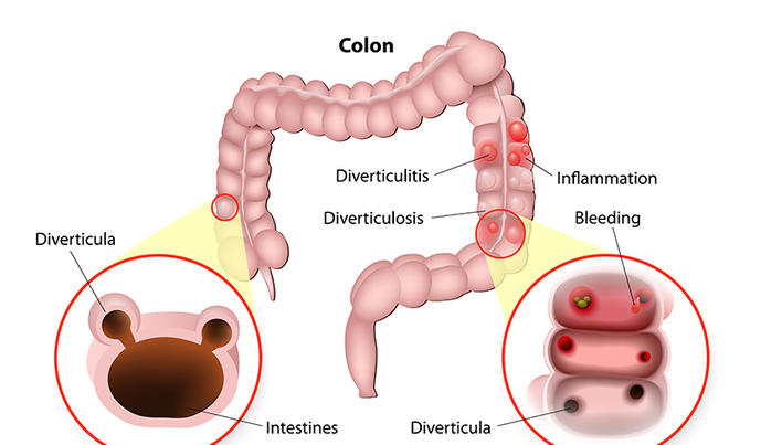 colon inflamat