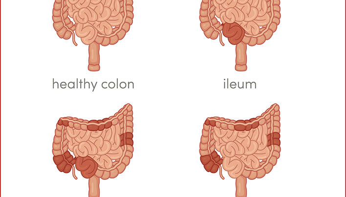 Cum se manifesta boala Crohn: simptome