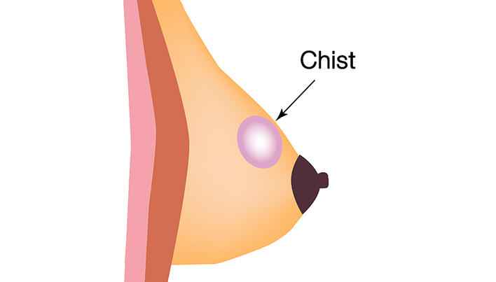 cum să tratezi un chist în prostatită metoda populară de tratare a prostatitei