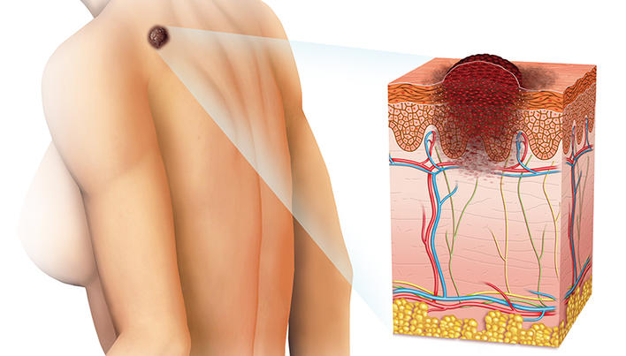Metastazele in cancerul de piele