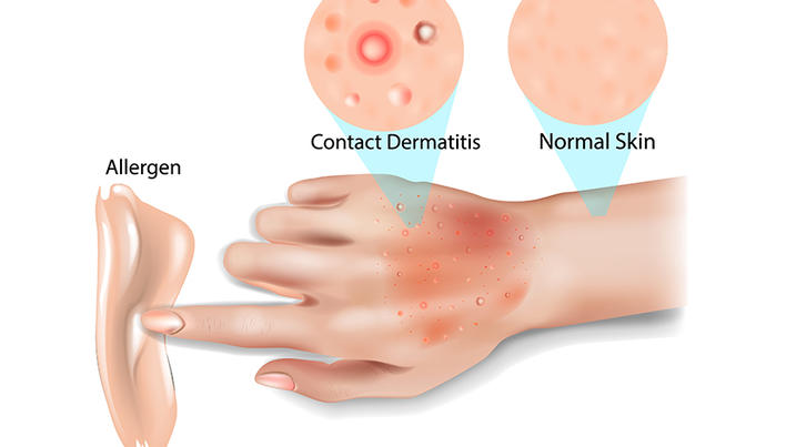 dermatita alergica de contact