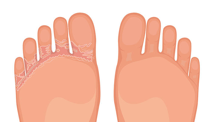 tratamentul pielii între degetele de la picioare