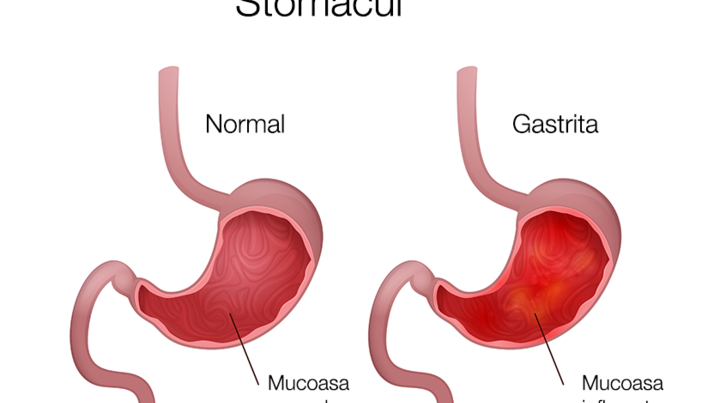 Ulcer stomacal și dureri articulare. Navigare principală