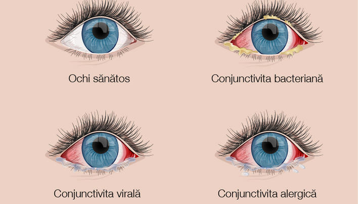 Scăderea vederii, umflarea ochilor. Tulburările de vedere în timpul sarcinii | oftalmo