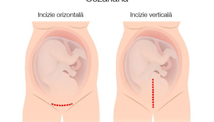 Varicoza în timpul cezarianului - Cezariana cu varice ale uterului vaginului este periculoasă