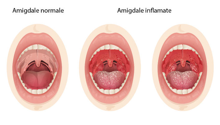 Amigdalita cronică. Tot ce trebuie să ştii despre această infecţie | Click