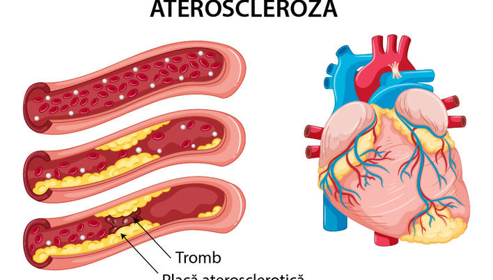 ateroscleroza i venele varicoase ce diferena