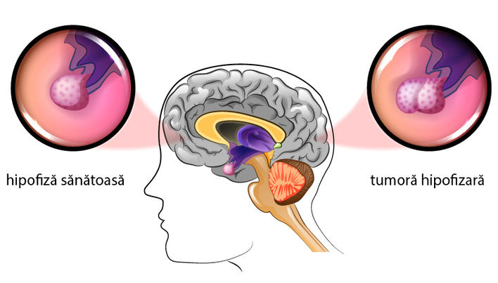Anevrismul cerebral / Tratament durere de cap, paralizii preventie AVC