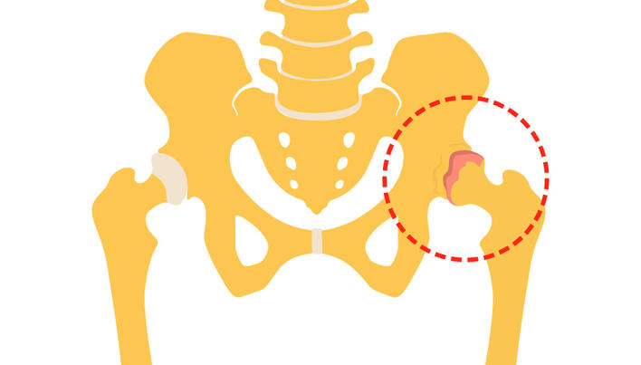 simptome de artroză la șold cauzele
