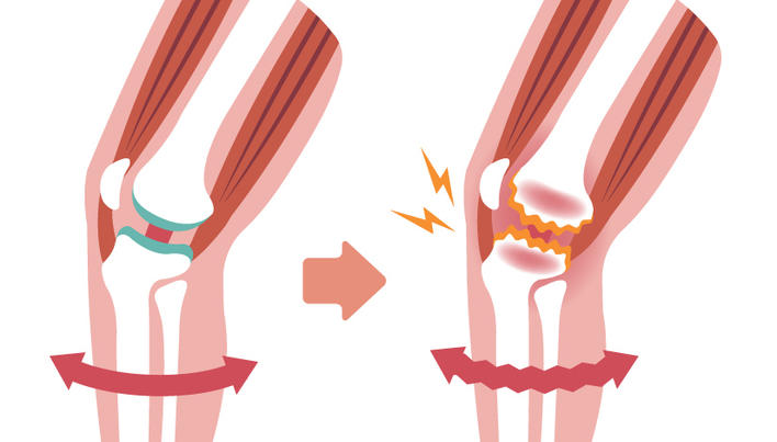 tratarea meniscului genunchiului