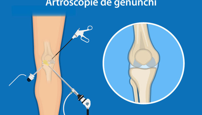 cum să tratezi o fisură în articulația genunchiului