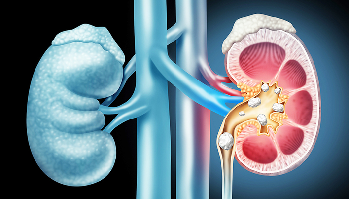tratament pt pietre la rinichi ce supozitoare sunt bune pentru prostatită