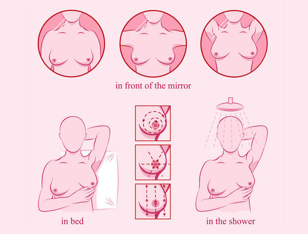 cancerul glandei mamare este
