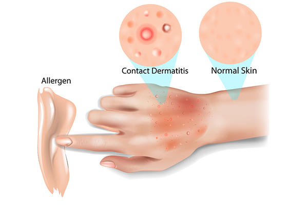 Problemele pielii pe timpul verii: cum le putem evita