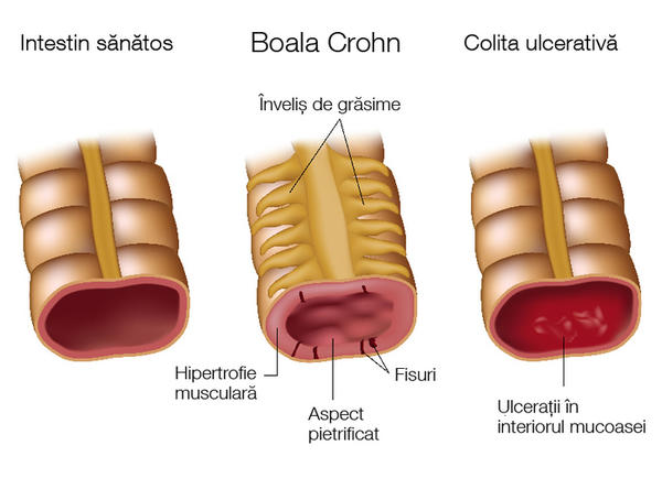 afectarea articulară în boala Crohn tratamentul articulației cu artrita reumatoidă