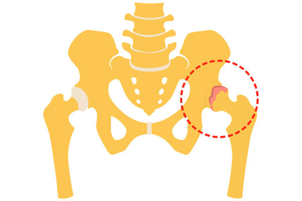 simptome de artroză la șold și tratament nutrițional