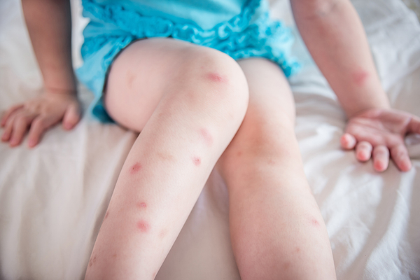 Cum doare picioarele cu varice, primul ajutor în lupta împotriva durerii - Embolie
