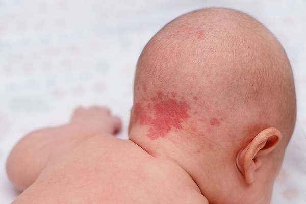 Simptom APLV: Bebelusi carora li se umfla diferite zone ale corpului