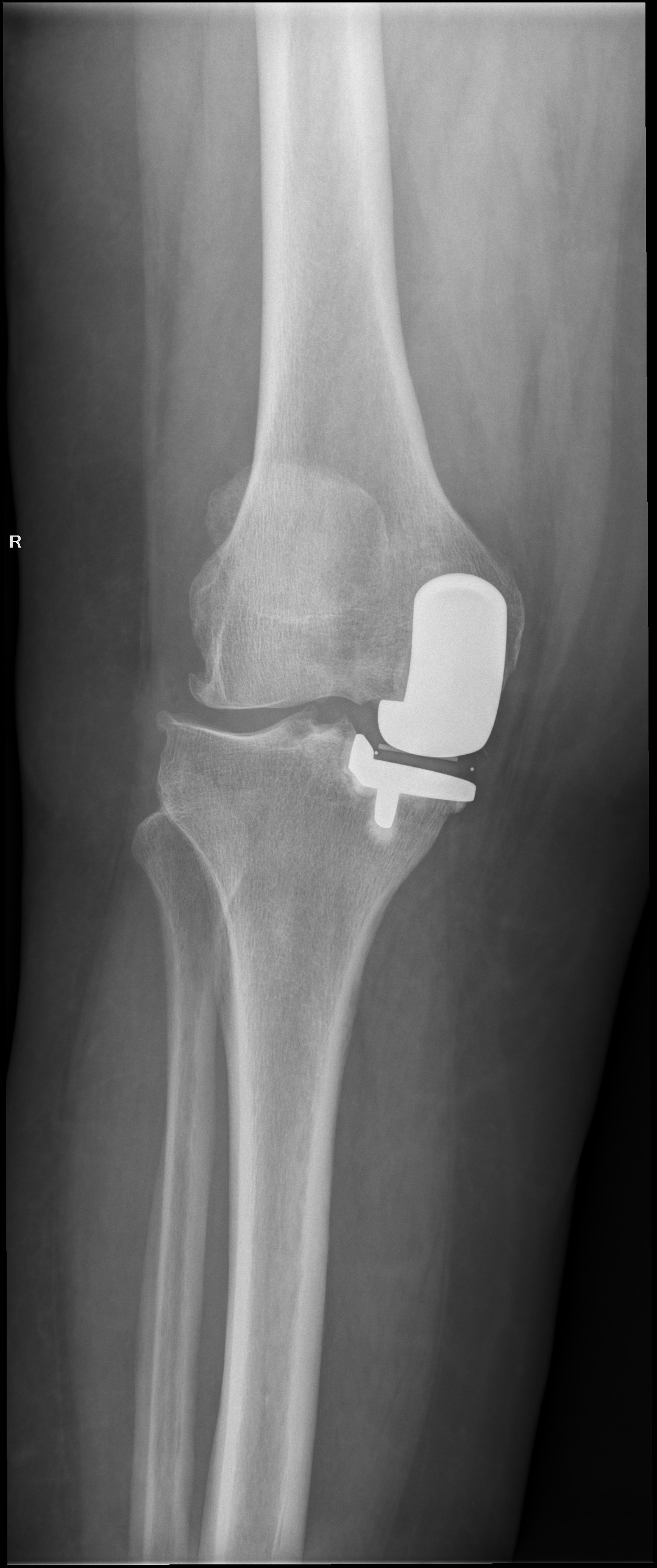 dureri de artroplastie la genunchi după operație