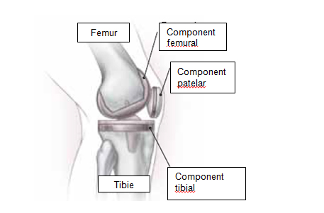 dureri postoperatorii ale artroplastiei genunchiului