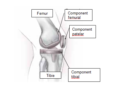 articulația artificială a genunchiului)
