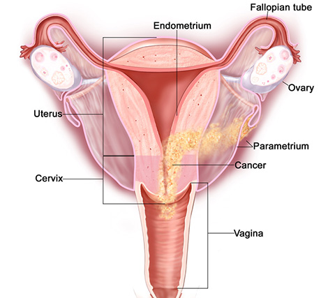 cancerul organelor genitale la femei)