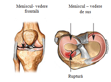 Ce înseamnă restaurarea cartilajului. Cum de a restabili cartilajul coloanei vertebrale