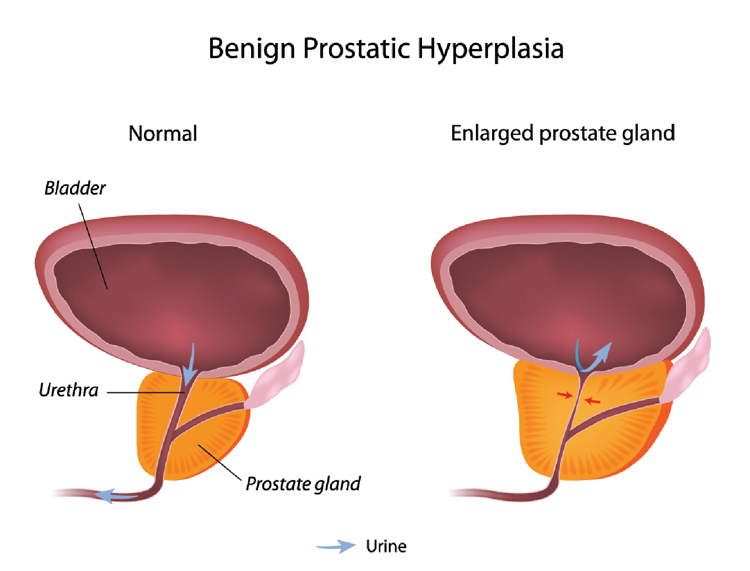 luând secreții de prostată inflamație a rectului cu prostatită