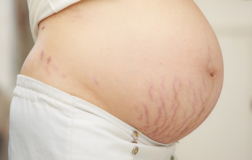Pierdere în greutate de 10 săptămâni înainte și după, Pierderea unei sarcini si moartea neonatala