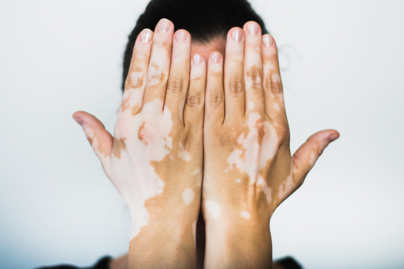 vitiligo și dureri articulare