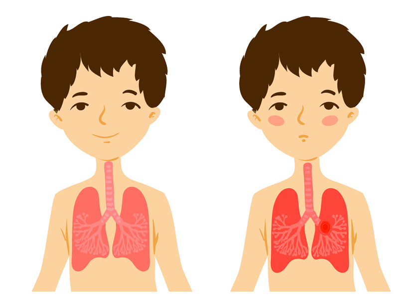 Pneumonia bacteriana la copii se poate complica cu pleurezie cand in cavitatea pleurala se acumuleaza lichid in exces