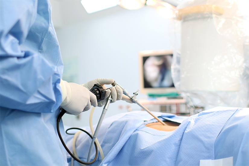 Ce este operatia laparoscopica prin incizie unica prin ombilic SILS?